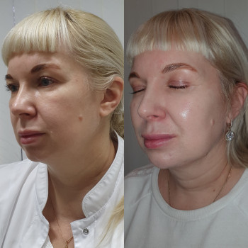 Комплексна корекція