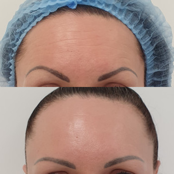 Ботулінотерапія