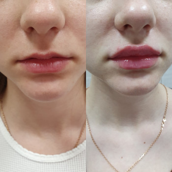 Аугментація губ, Xcelens 3