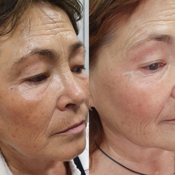 Ретиноєвий пілінг, до та після однієї процедури