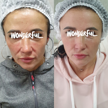 Біоревіталізація