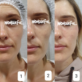 Контурна пластика + бланч терапія