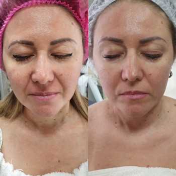 Корекція носогубних валіків