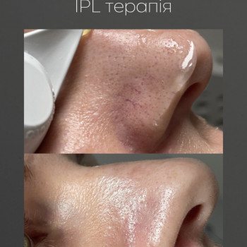 IPL терапія
                    Дерматолог косметолог Марта Львів