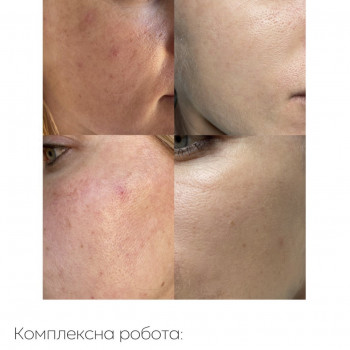 IPL терапія
                    Дерматолог косметолог Марта Львів