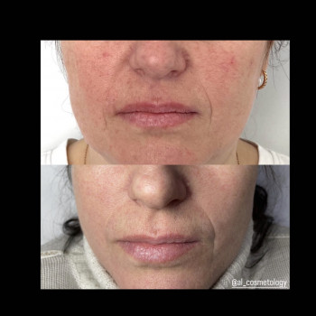 IPL терапія
                    Дерматолог косметолог Марта Львів