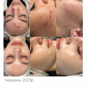 Лікування акне
                    Дерматолог косметолог Марта Львів