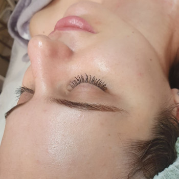 Стан шкіри після процедури ензимної ферментотерапії