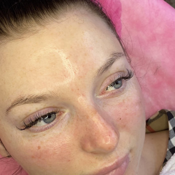 Механічна чистка обличчя