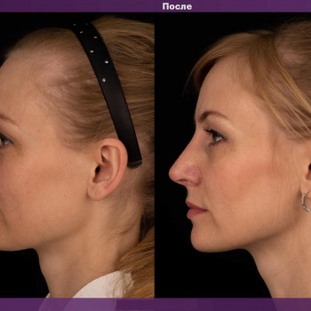 Фото з портфоліо фахівця Світлана Работенко (пластичний хірург, Львів)