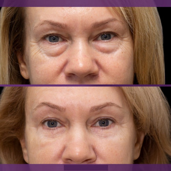 Блефаропластика нижніх повік, фото - пластичний хірург Світлана Работенко