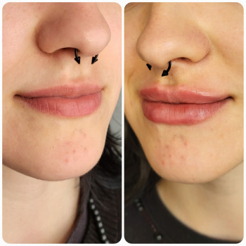 Збільшення губ, Stylage S 0.8ml