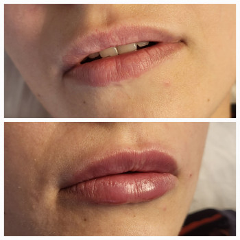 Збільшення губ, Алекса, 1мл