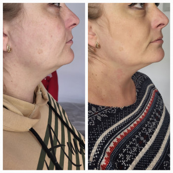 Процедура "Худое лицо", результат 2х процедур