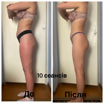 Вакуумно-роликовий масаж
                    Массажист Виктория Ирпень