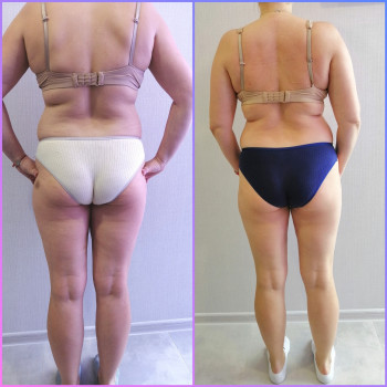 Вакуумно-роликовий масаж
                    Массажист Виктория Ирпень