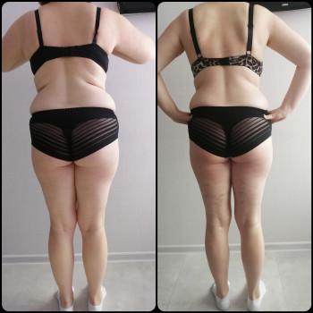 Вакуумно-роликовий масаж
                    Массажист Виктория Ирпень