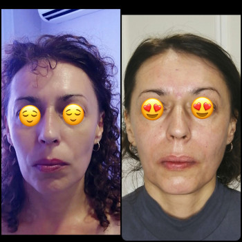 Міофасциальний масаж обличчя
                    Массажист Виктория Ирпень