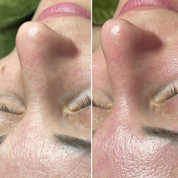 Комбінована чистка обличчя