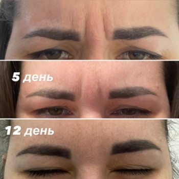 Ботокс міжбрівка ,лоб