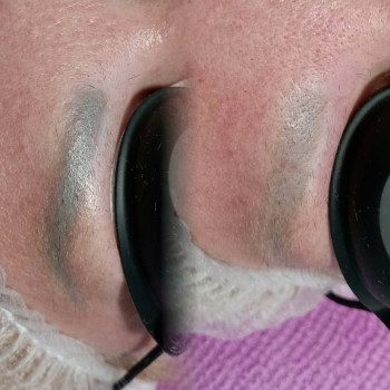 лазерное удаление