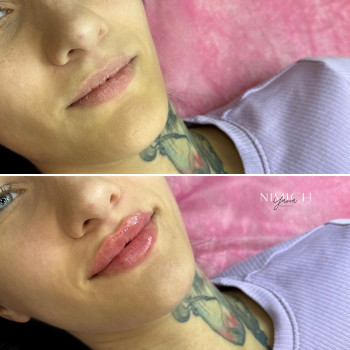 Збільшення губ 
(Перша процедура 1мл)