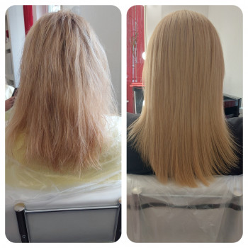 Колагенопластія
Процедура 3
Відновлення лише кінчиків)