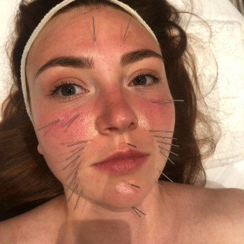 Face Lifting Acupuncture (голки)
                    Масажист Николай Київ