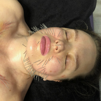 Face Lifting Acupuncture (голки)
                    Масажист Николай Київ