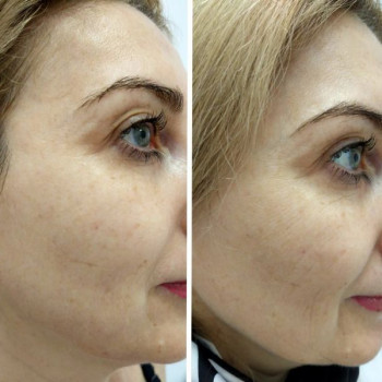 Микротоковая терапия
                    Косметолог-эстетист Влада Харьков