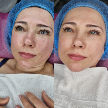 Аквачистка, аквапилинг, гидропилинг.Hydrafacial
                    Косметолог-естетист Влада Харків