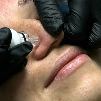 Аквачистка, аквапилинг, гидропилинг.Hydrafacial
                    Косметолог-естетист Влада Харків