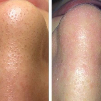 Механическая чистка