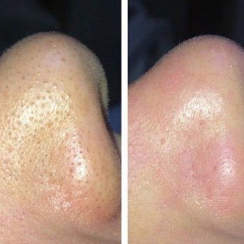 Механическая чистка