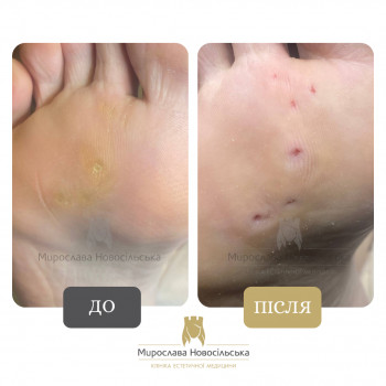 обробка бородавки в Ужгороді