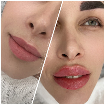 Збільшення губ
                    Косметолог-инъекционист Наталья Днепр