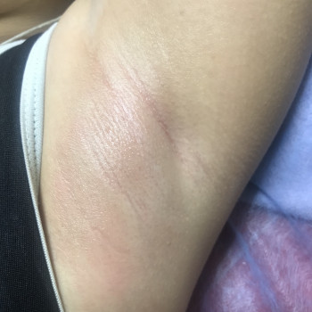 Шугаринг пахви (подмишки)
                    Мастер депиляции Людмила Одесса