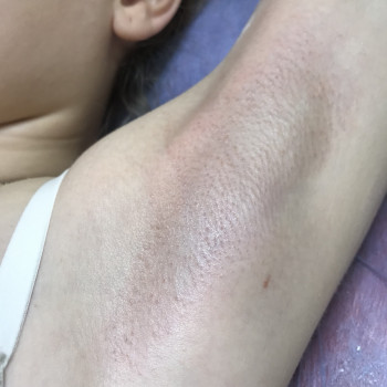 Шугаринг пахви (подмишки)
                    Мастер депиляции Людмила Одесса