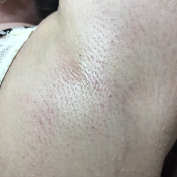 Шугаринг пахви (подмишки)
                    Мастер депиляции Людмила Одесса