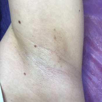 Шугаринг пахви (подмишки)
                    Мастер депиляции Людмила Одесса