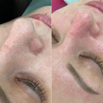 Результат чистки обличчя