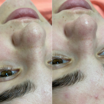 Чистка обличчя