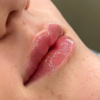 Збільшення губ аугментація, фото - Викладач курсів краси Дарья Евтушенко