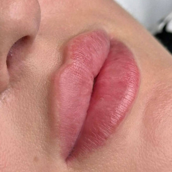 Збільшення губ аугментація, фото - Викладач курсів краси Дарья Евтушенко