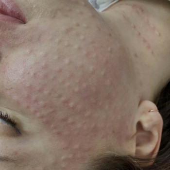 Мезотерапія обличчя
                    Косметолог Вероніка Винница