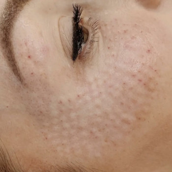 Мезотерапія обличчя
                    Косметолог Вероніка Винница