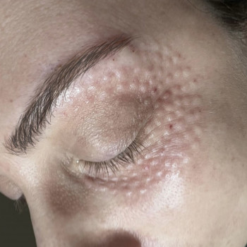 Мезотерапія обличчя
                    Косметолог Вероніка Винница