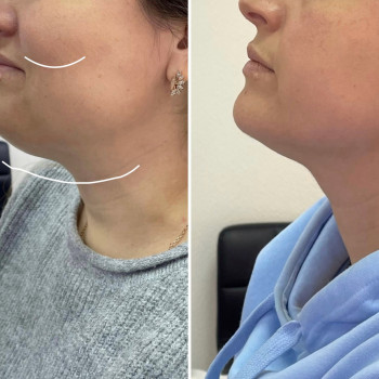 Ліполітик підборіддя