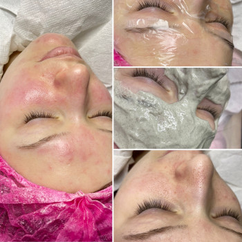 Чистка обличчя