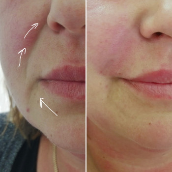 Контурна пластика носогубних складок філером